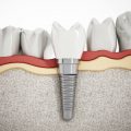 Rodzaje implant&oacute;w zęb&oacute;w