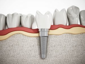Rodzaje implantów zębów