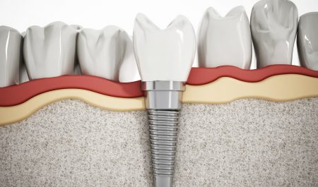 Rodzaje implantów zębów
