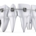 teeth implants