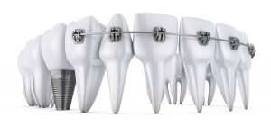 teeth implants