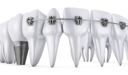 teeth implants