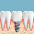 Wizualizacja wszczepionego implantu zęba