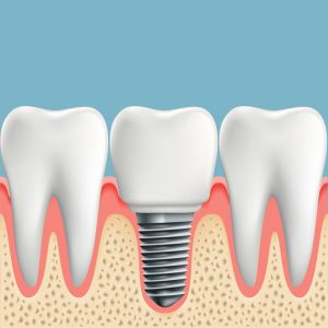 Wizualizacja wszczepionego implantu zęba