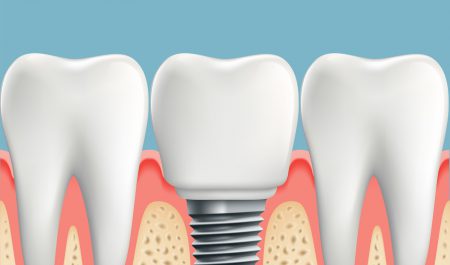 Wizualizacja wszczepionego implantu zęba