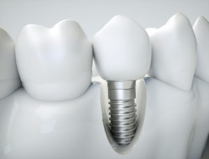 przekrój implantu zęba