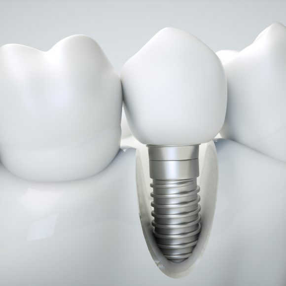 przekr&oacute;j implantu zęba