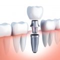Implant zęba