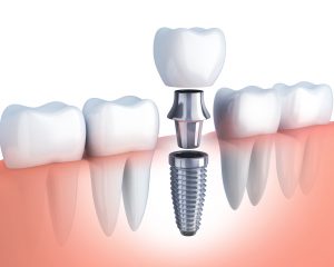 Implant zęba