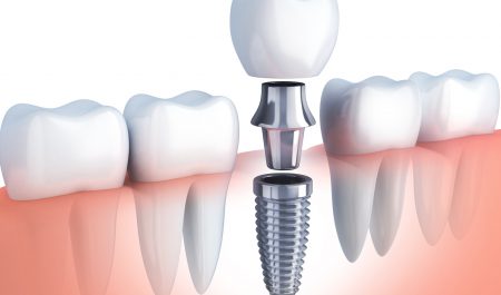 Implant zęba