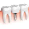 Implant po ekstrakcji
