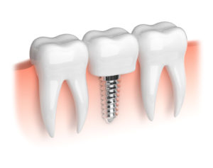 Implant po ekstrakcji