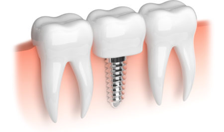 Implant po ekstrakcji