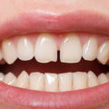 Diastema - przerwa między zębami