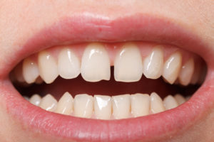 Diastema - przerwa między zębami