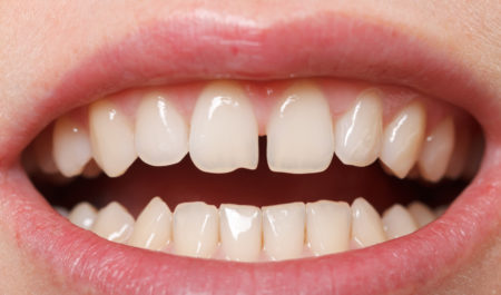 Diastema - przerwa między zębami