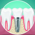 Osteointegracja