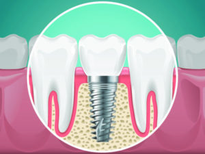 Osteointegracja
