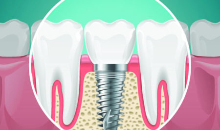 Osteointegracja