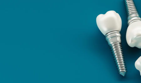 Ranking implantów zębów
