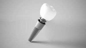Implant zęba wykonany z metalu i korona