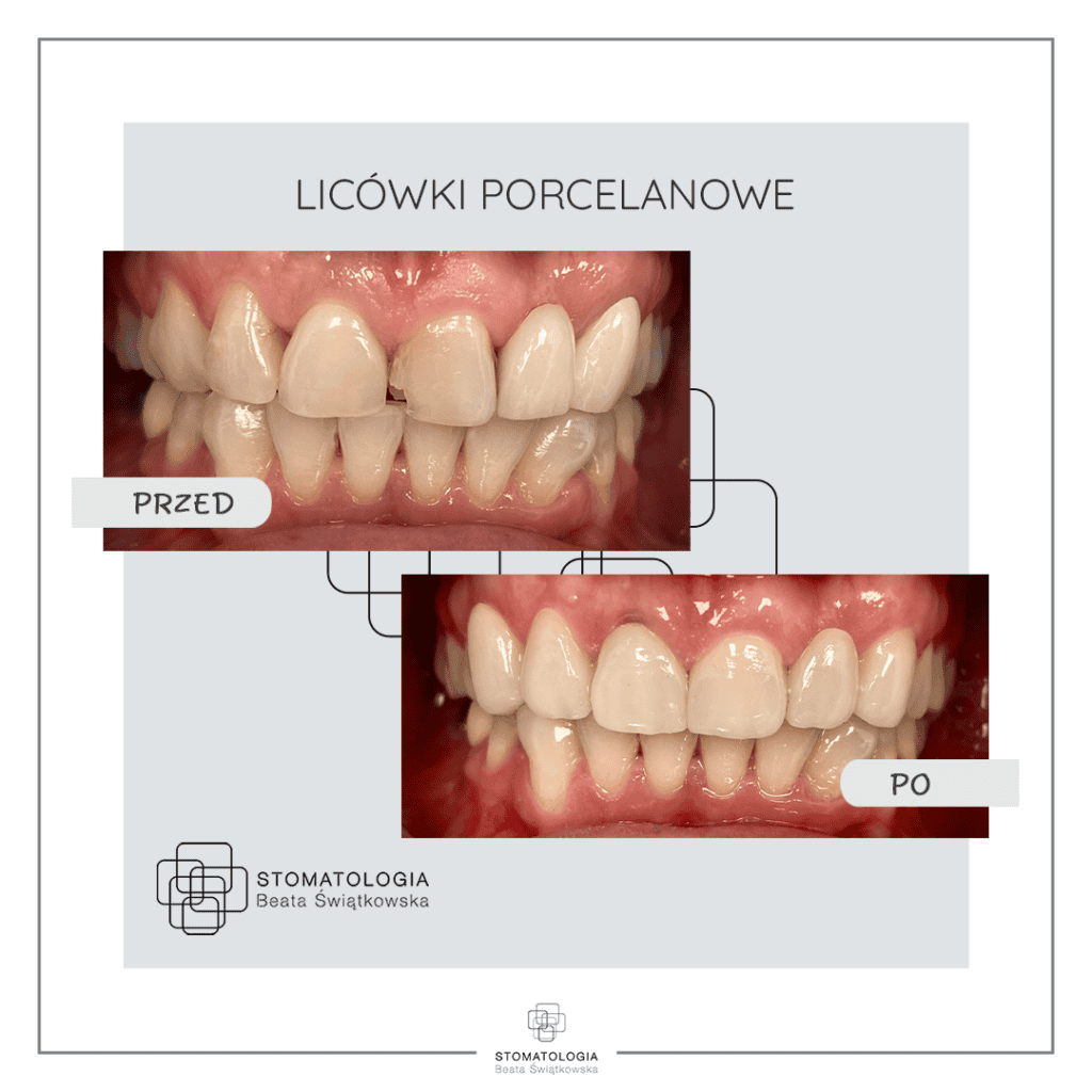 Licowki Porcelanowe 1