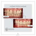Licowki Porcelanowe