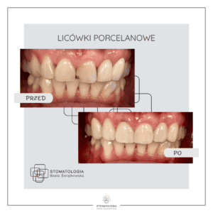 Licowki Porcelanowe